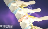 三维动画演示医学腰椎手术视频